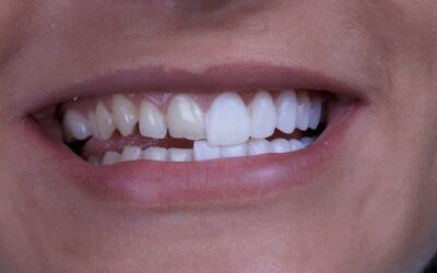 Carillas dentales: tipos, precios y duración