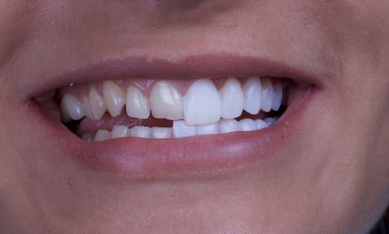 Carillas-dentales