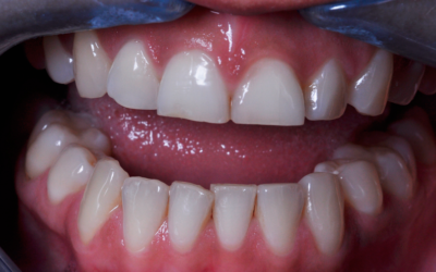 Dientes desgastados: causas y tratamientos para recuperar tu sonrisa