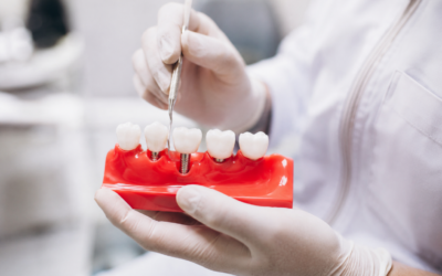 ¿Cuánto dura un implante dental? 7 factores clave que debes conocer en 2026